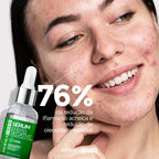 Sérum Facial DERMACHEM 30ml Efeito Secativo – Sérum para Pele Oleosa e com Acne, Controle da Oleosidade e Cuidado Facial
